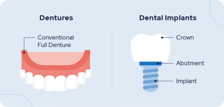 Dentures vs Implants