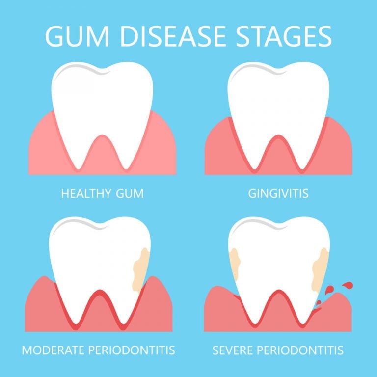 Stages of gum disease